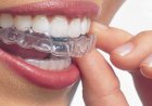 What is removable orthodontic treatment? Benefits and ideal age