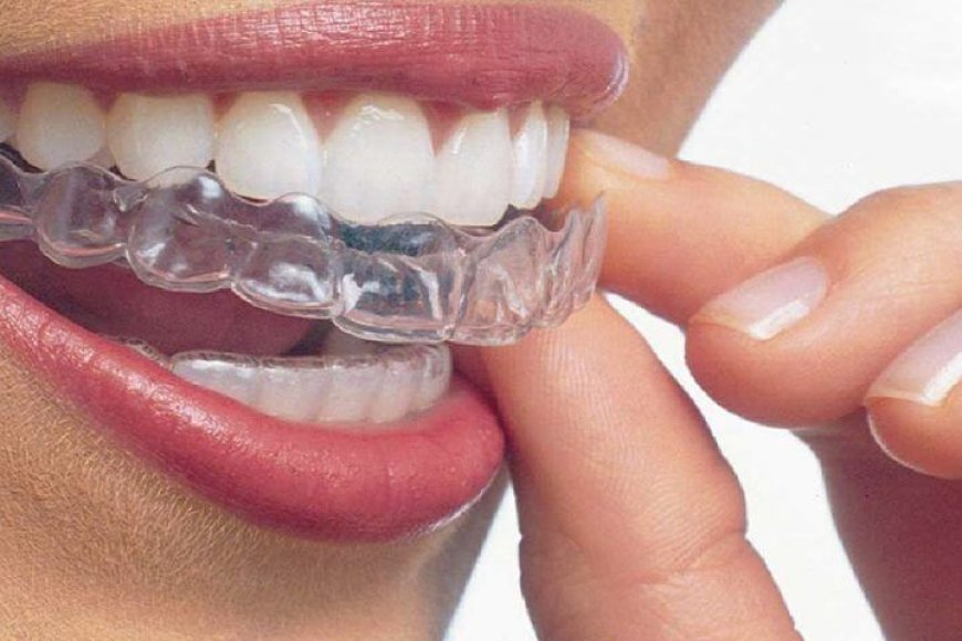What is removable orthodontic treatment? Benefits and ideal age