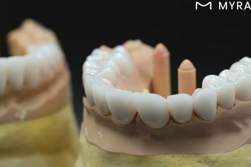 Top 6 dental veneer methods for a perfect smile in Antalya