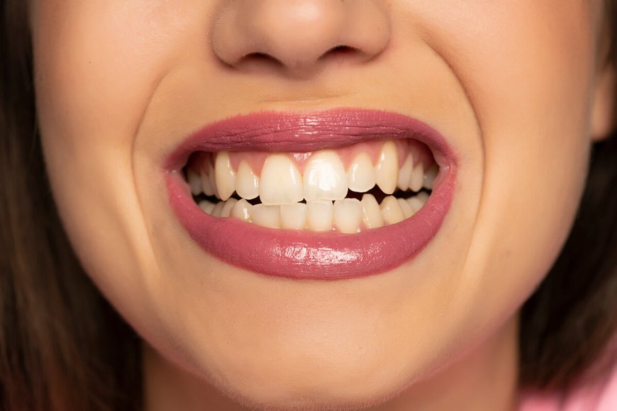 Understanding Bruxism: Causes, Symptoms, and Dental Treatments